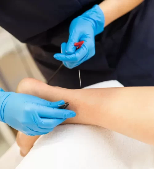 Acupuncture-Dry-needling-768x768