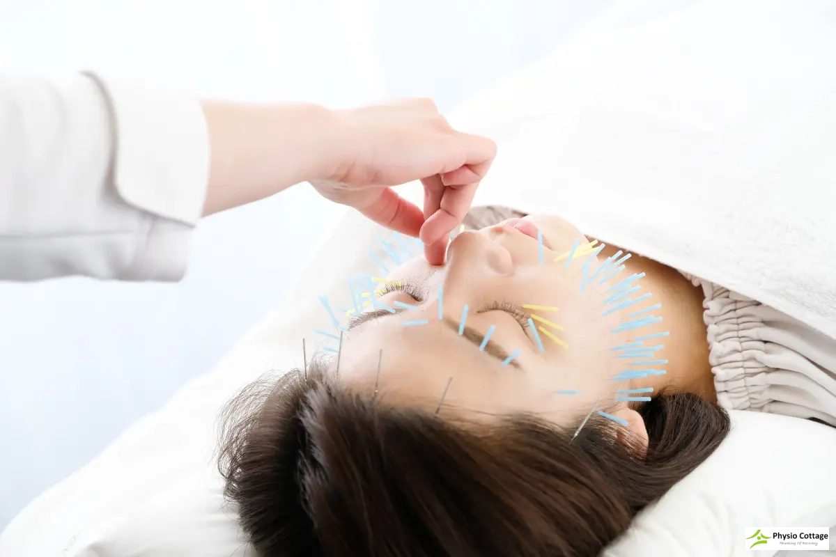 Registered acupuncturist treating a patient at Physio Cottage in Scarborough