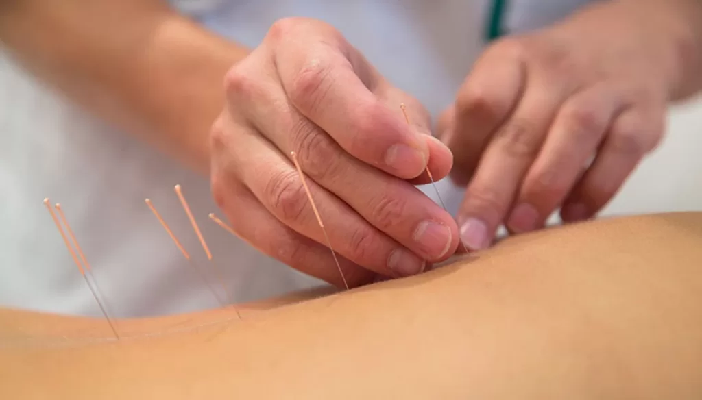 Is Acupuncture Covered By OHIP