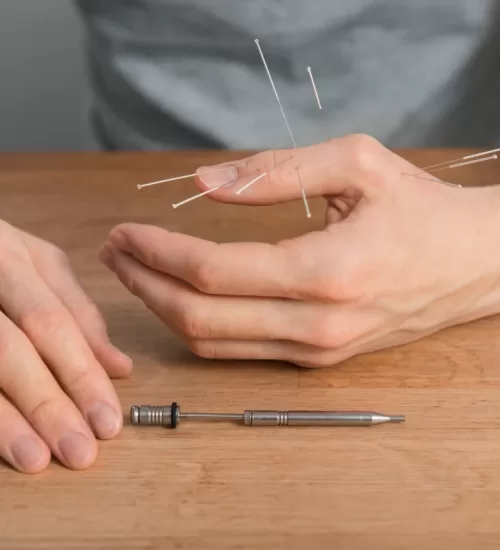 Acupuncture for Carpal Tunnel Syndrome Acupuncture for Carpal Tunnel Syndrome