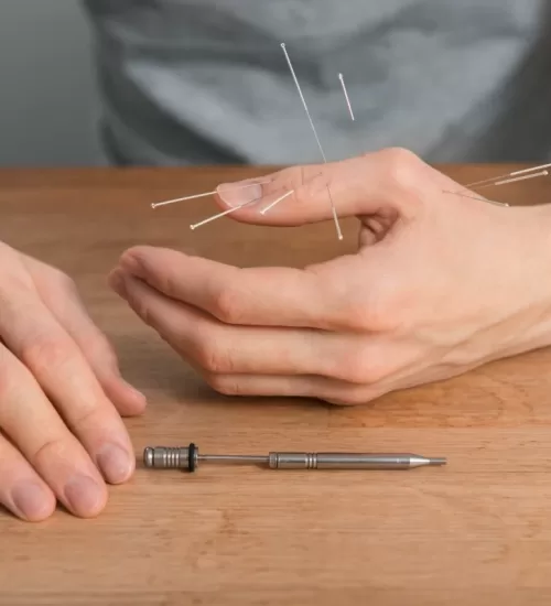 Acupuncture for Carpal Tunnel Syndrome